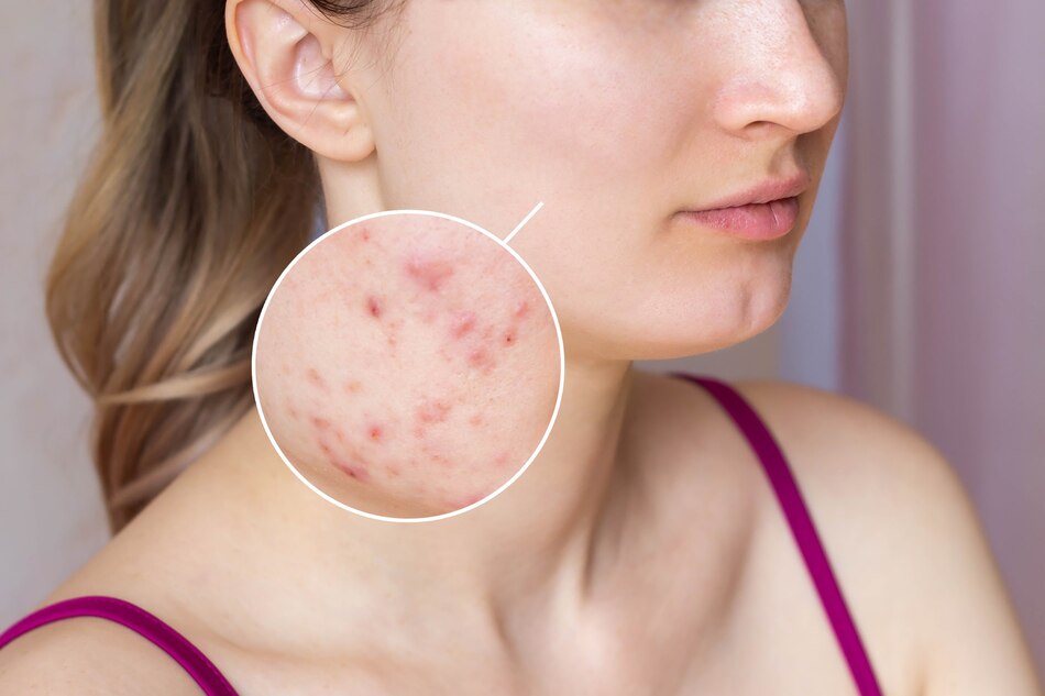 The Most Powerful Skincare Regimen‎ For Acne-Prone Skin